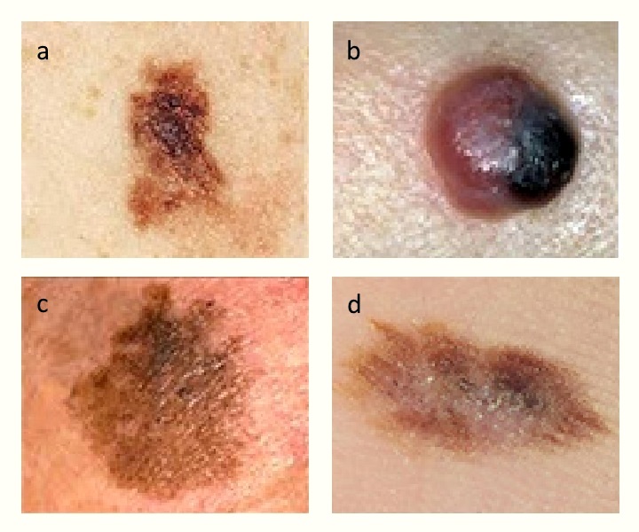 Nodular Melanoma Treatment In London Skin Care Network