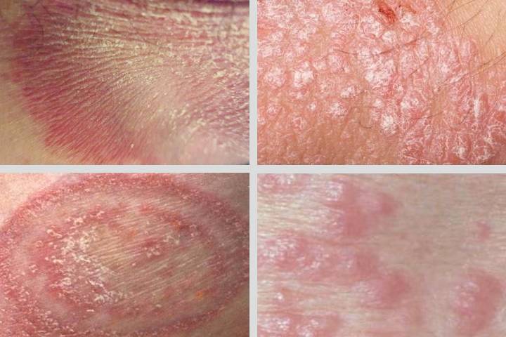 RACGP - A red scaly rash to the groin
