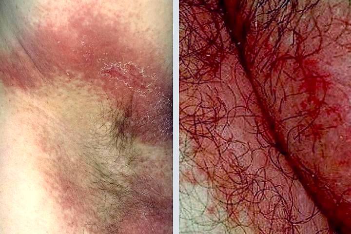 Chafing vs. Sweat Rash: Understanding the Differences